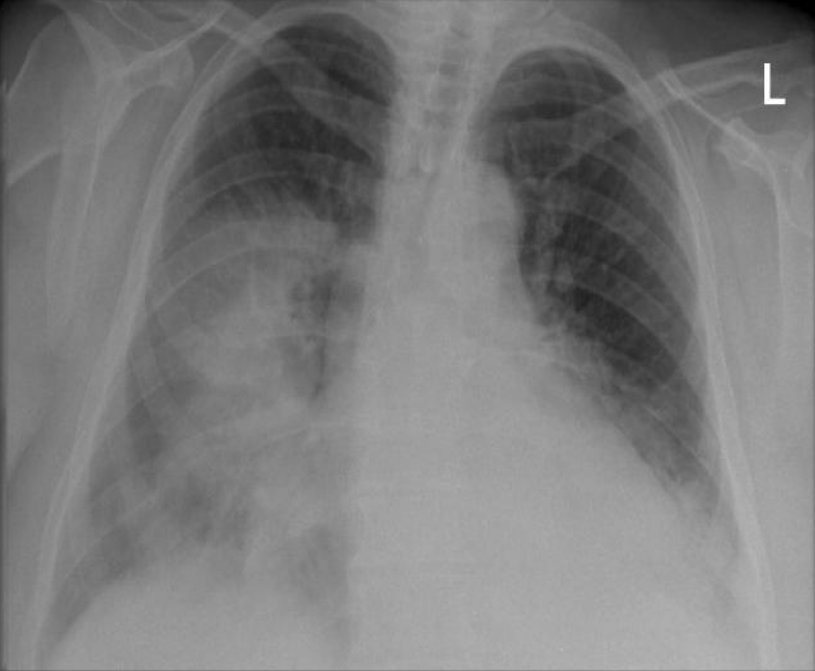 Importancia de la pulmonia en niños y personas mayores